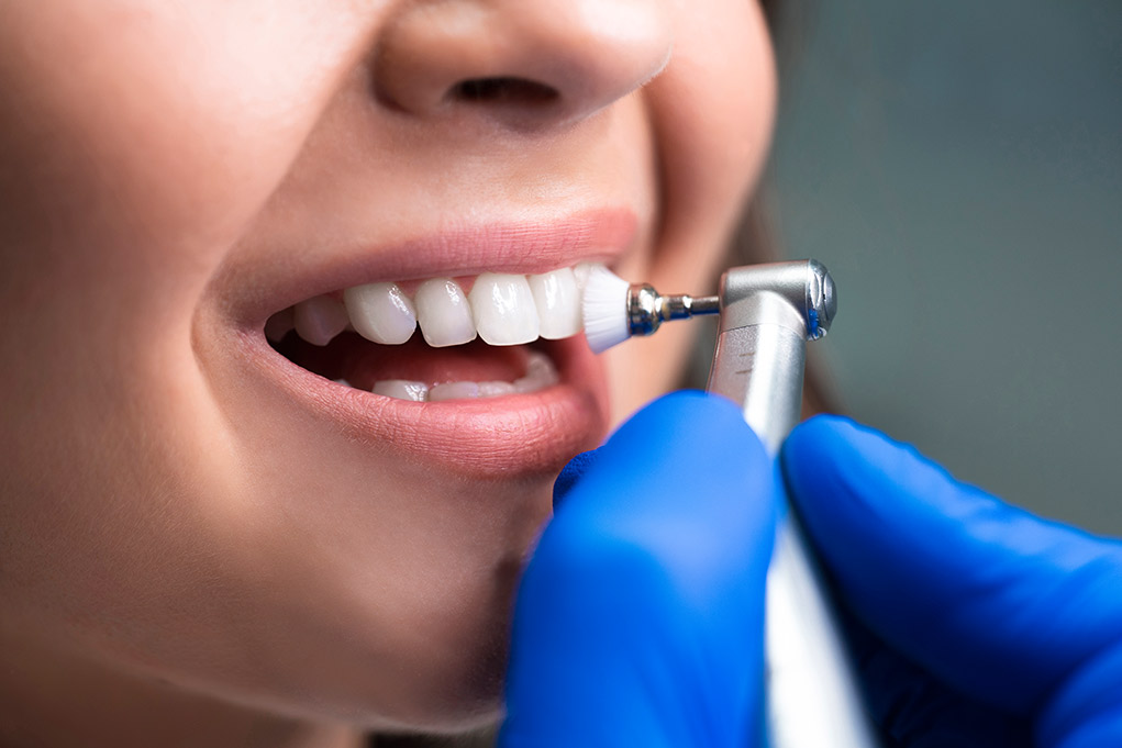 Limpieza Dental